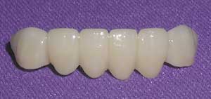 Porcelain Fixed Dental Bridges by Dr. David Richardson - Charleston South Carolina Dentist