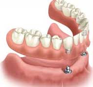 Dental Implant Retained Removable Dentures by Dr. David Richardson - Charleston South Carolina Implant Dentist