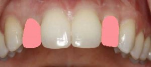 Before and After Photos of Porcelain Tooth Crowns:
