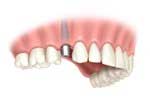 Dental Implants by Dr. David Richardson - Charleston South Carolina Implant Dentist