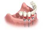 Full Arch Replacement Dental Implants by Dr. David Richardson - Charleston South Carolina Implant Dentist