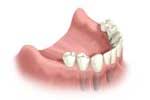 Full Arch Replacement Dental Implants by Dr. David Richardson - Charleston South Carolina Implant Dentist