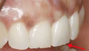 Porcelain Tooth Crowns by Dr. David Richardson - Charleston South Carolina Implant Dentist
