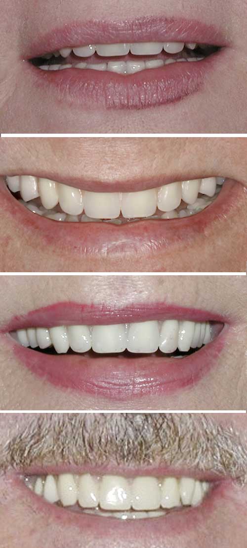 Dentures by Dr. David Richardson - Charleston South Carolina Implant Dentist