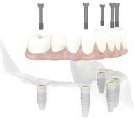 Dental Implant Supported Fixed Dentures by Dr. David Richardson - Charleston South Carolina Implant Dentist
