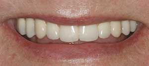 Dental Implant Supported Fixed Dentures by Dr. David Richardson - Charleston South Carolina Implant Dentist