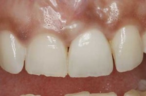 Before and After Photos of Porcelain Tooth Crowns:
