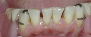 Partial Dentures by Dr. David Richardson - Charleston South Carolina Implant Dentist