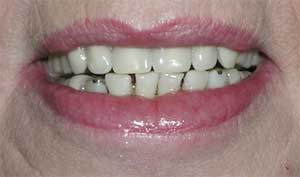 Partial Dentures by Dr. David Richardson - Charleston South Carolina Implant Dentist