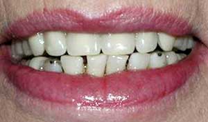 Replacing upper front teeth
