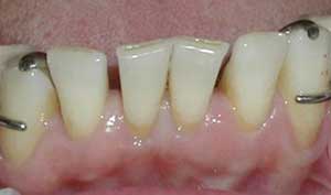 Replacing upper front teeth