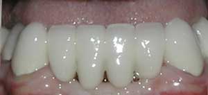 Porcelain Fixed Tooth Bridges by Dr. David Richardson - Charleston SC Dentist