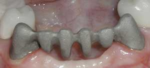 Porcelain Fixed Tooth Bridges by Dr. David Richardson - Charleston SC Dentist