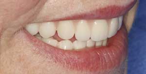 Dental Implant Retained Removable Dentures by Dr. David Richardson - Charleston South Carolina Implant Dentist