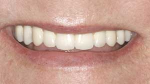 Dental Implants by Dr. David Richardson - Charleston South Carolina Dentist