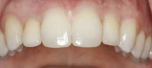 Dental Bridges by Dr. David Richardson - Charleston South Carolina Dentist