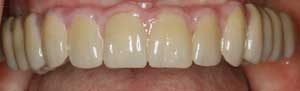 Dental Bridges by Dr. David Richardson - Charleston South Carolina Dentist