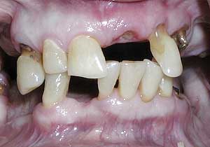 Dentures by Dr. David Richardson - Charleston South Carolina Implant Dentist