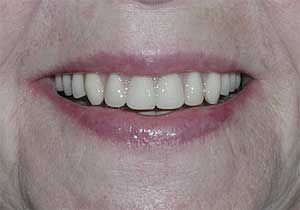 Smile Makeovers by Dr. David Richardson - Charleston South Carolina Dentist