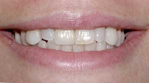 Tooth Crowns by Dr. David Richardson - Charleston South Carolina Dentist